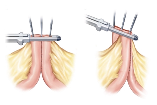 New Surgical Technique Developed to Reduce Crohn’s Disease Complications