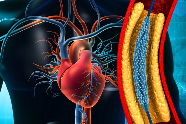 Stent Procedures Proven Safe with Standard Drug Therapy Even for High Risk Patients